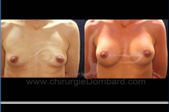 Borstvergroting (met implantaten)