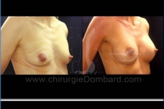 Borstvergroting (met implantaten)