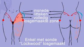 bodylift-wat-gebeurt-er-na-de-operatie-brussels-belgium-dr-dombard