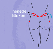 Bodylift insnede litteken