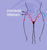 Bodylift insnede litteken