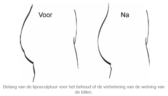 liposculptuur-liposuctie-zones-brussels-belgium-dr-dombard