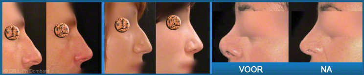 Neuscorrectie Rhinoplastiek