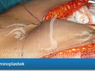 Abdominoplastiek - Naar elkaar toehechten van de buikspieren - resectie van overtollige huid en vetweefsel