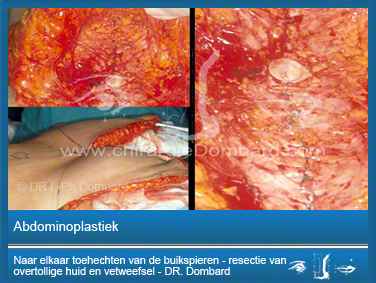Abdominoplastiek - Naar elkaar toehechten van de buikspieren - resectie van overtollige huid en vetweefsel