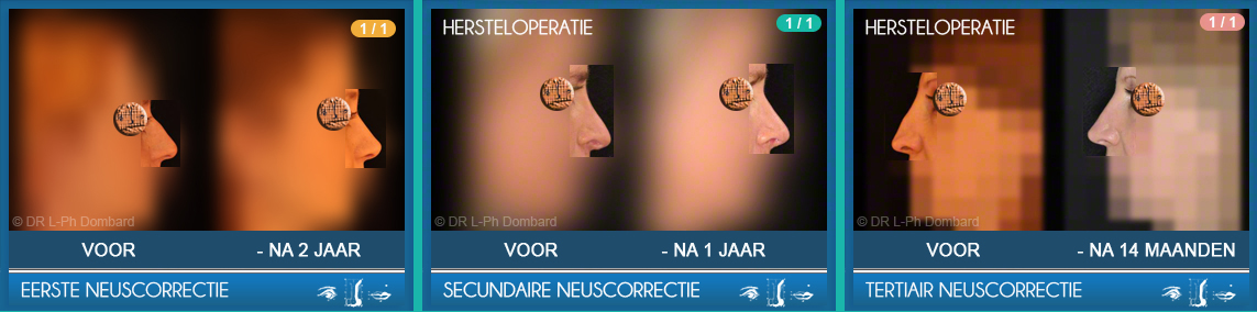 Eerste neuscorrectie - Secundaire neuscorrectie - Tertiair neuscorrectie