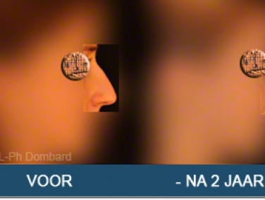 Eerste neuscorrectie Voor -Na 2 Jaar