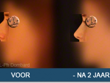 Eerste neuscorrectie Voor -Na 2 Jaar
