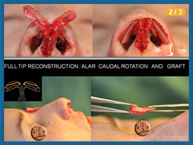 Eerste neuscorrectie - Plastische chirurgie neus in België