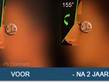 Eerste neuscorrectie Voor -Na 2 Jaar - Angle fronto-nasal