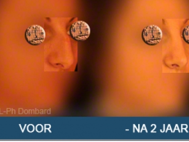 Eerste neuscorrectie Voor -Na 2 Jaar