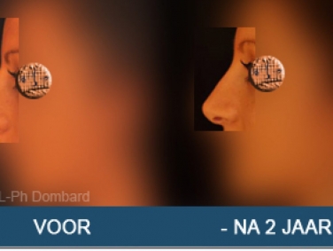 Eerste neuscorrectie Voor -Na 2 Jaar