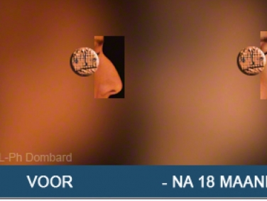 Eerste neuscorrectie Voor -Na 18 Maanden