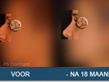 Eerste neuscorrectie Voor -Na 18 Maanden