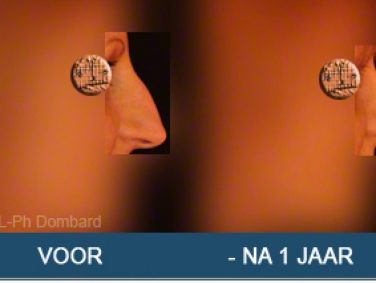 Eerste neuscorrectie Voor -Na 1 Jaar