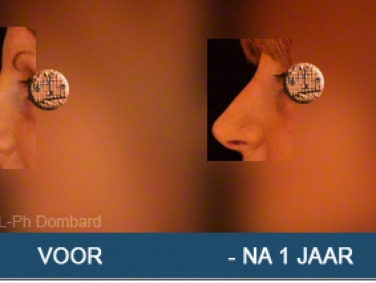 Eerste neuscorrectie Voor -Na 1 Jaar