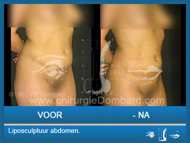 Liposculptuur liposuctie abdomen.