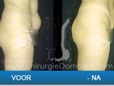 Liposculptuur liposuctie Liposculptuur abdomen & maag.