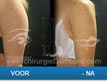 Liposculptuur achterzijde van de armen.