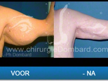 Liposculptuur en armlift.