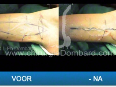 Liposculptuur en armlift.