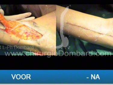 Liposculptuur en armlift.