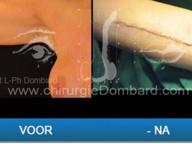 Liposculptuur en armlift.
