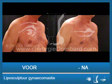 Liposculptuur liposuctie gynaecomastie.
