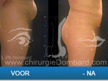 Liposculptuur liposuctie van taille en heupen - abdomen & maag.