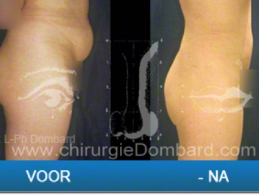 Liposculptuur liposuctie van taille en heupen ) abdomen & maag.