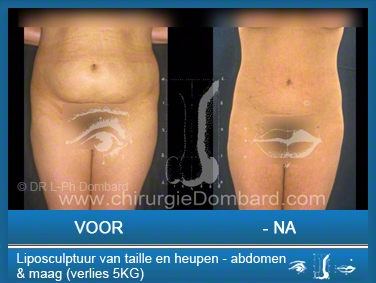Liposculptuur liposuctie van taille en heupen - abdomen & maag - verlies 5KG