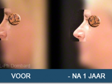 Secundaire neuscorrectie Hersteloperatie Voor -Na 1 Jaar