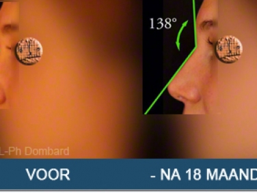 Secundaire neuscorrectie Hersteloperatie Voor -Na 18 Maanden