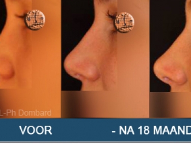 Secundaire neuscorrectie Hersteloperatie Voor -Na 18 Maanden