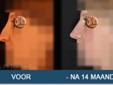 Tertiair neuscorrectie Hersteloperatie Voor -Na 14 Maanden