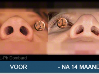 Tertiair neuscorrectie Hersteloperatie Voor -Na 14 Maanden