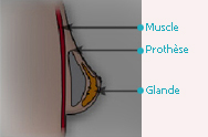 Augmentation mammaire
