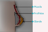 Augmentation mammaire