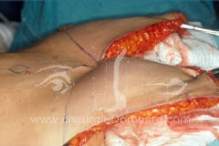 Plicature des muscles abdominaux - Resection excès de peau et de tissus graisseux - DR Dombard 2