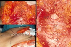Plicature des muscles abdominaux - Resection excès de peau et de tissus graisseux - DR Dombard 2