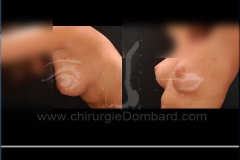 Seins Prothèses mammaire - DR Dombard Bruxelles Belgique