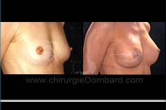 Seins Prothèses mammaire - DR Dombard Bruxelles Belgique