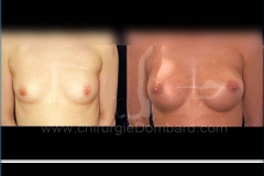 Seins Prothèses mammaire - DR Dombard Bruxelles Belgique