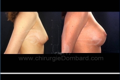 Seins Prothèses mammaire - DR Dombard Bruxelles Belgique