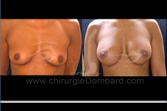 Seins Prothèses mammaire - DR Dombard Bruxelles Belgique