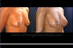 Seins Prothèses mammaire - DR Dombard Bruxelles Belgique