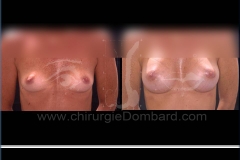 Seins Prothèses mammaire - DR Dombard Bruxelles Belgique