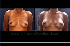 Seins Prothèses mammaire - DR Dombard Bruxelles Belgique