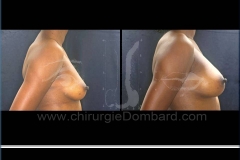 Seins Prothèses mammaire - DR Dombard Bruxelles Belgique