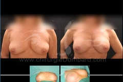 Seins Prothèses mammaire - DR Dombard Bruxelles Belgique